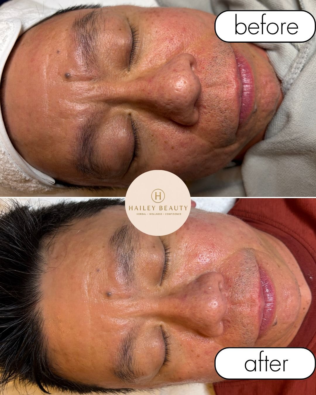 Before and after of male client — cheek redness and texture improved after Herbal Congestion and Brightening Facial