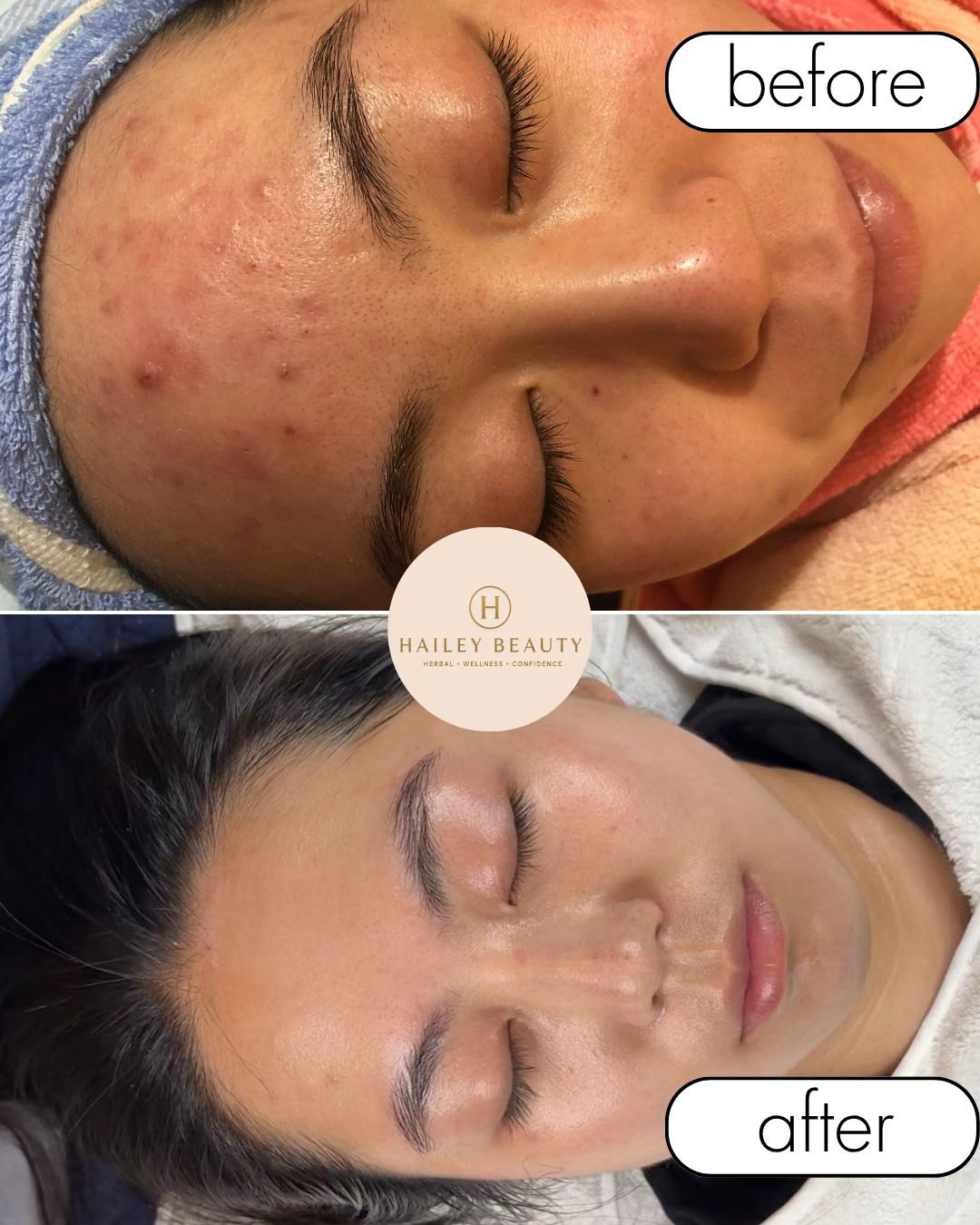 Before and after of female client — acne and redness significantly reduced after treatment