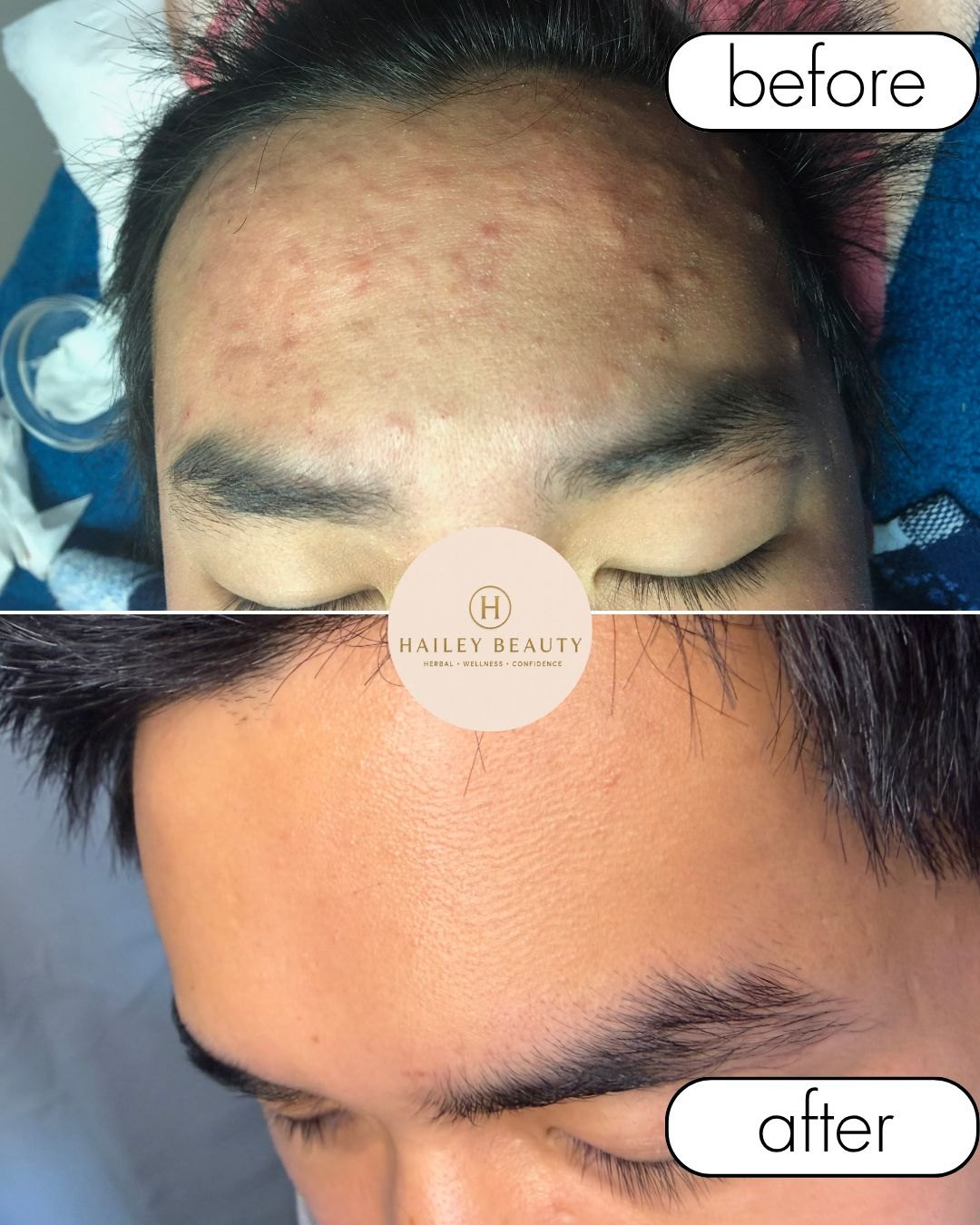 Before and after of male forehead — congestion and inflammation cleared after herbal treatment