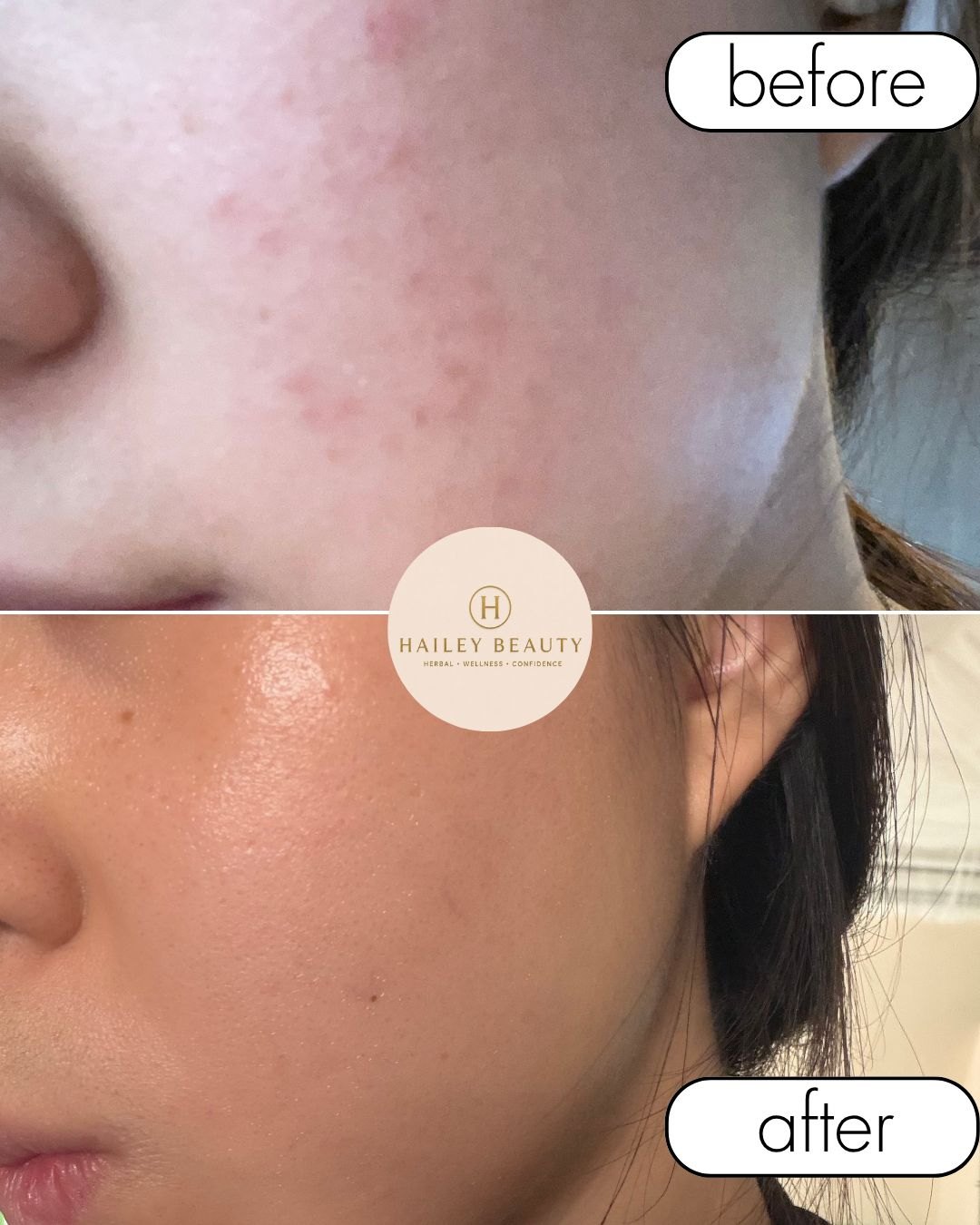 Before and after of cheek close-up — pigmentation and redness evened after treatment