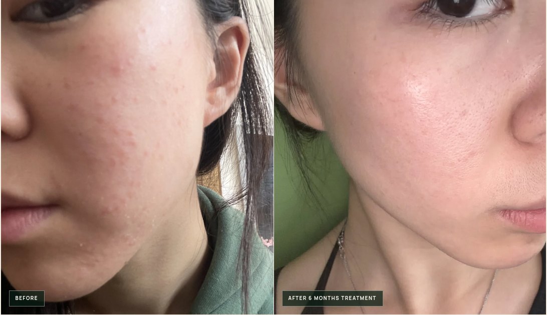 Before and after side-by-side — cheek acne and texture smoothed after six months of herbal treatment