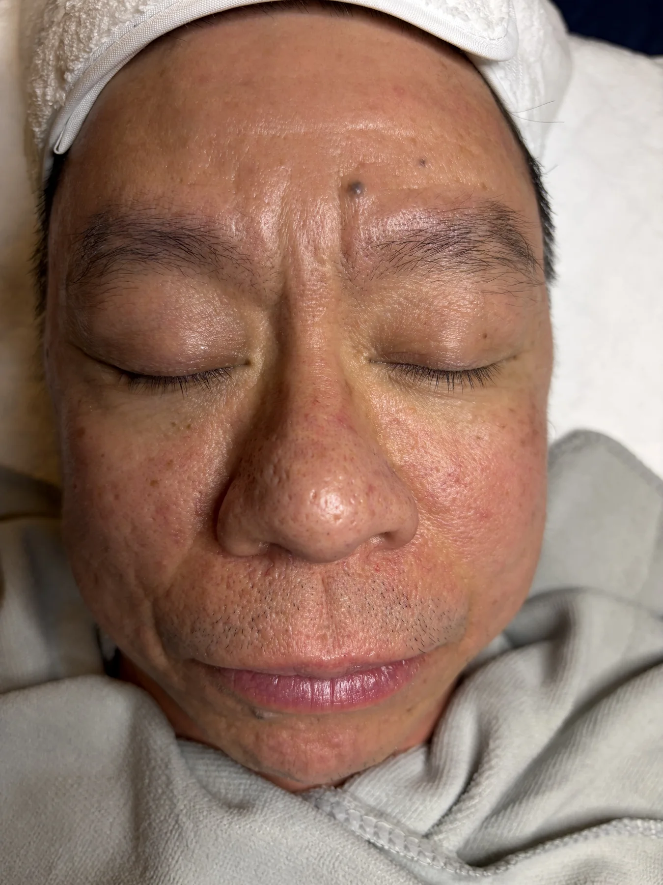 Client immediately after the Blue Crystal Brightening Treatment