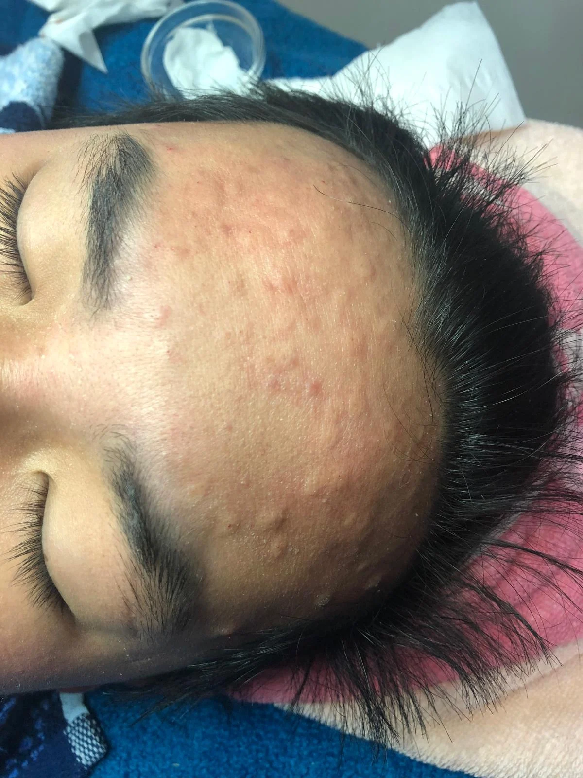 Client skin before treatment