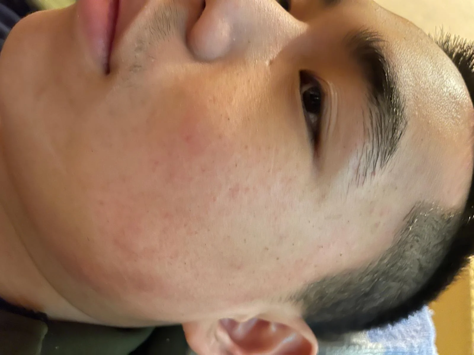 Client skin immediately after treatment